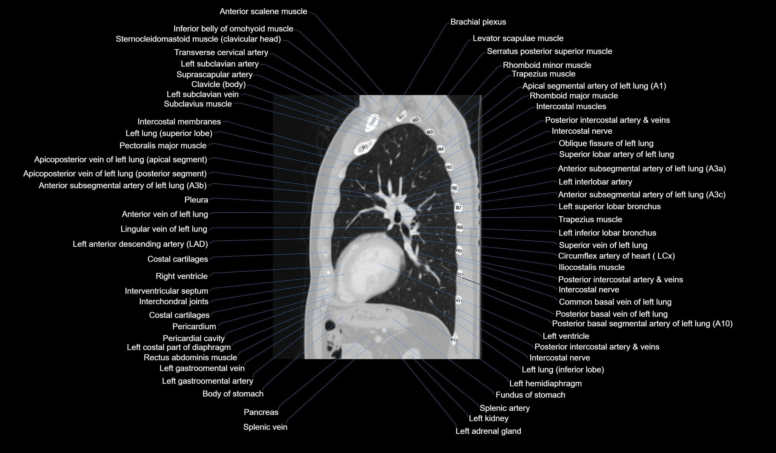 CT chest (thorax) lung window labelled sagittal cross sectional anatomy radiology image-00094.webp